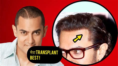 aamir khan hair transplant